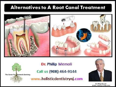 Holistic Dentistry Root Canal