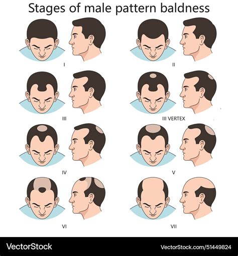 Hormonal Changes in Male Pattern Baldness