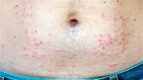 Hot Tub Folliculitis