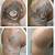 Houston Laser Tattoo Removal