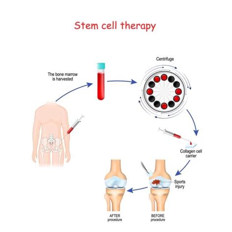 Houston Stem Cell Therapy: Understanding Your Options