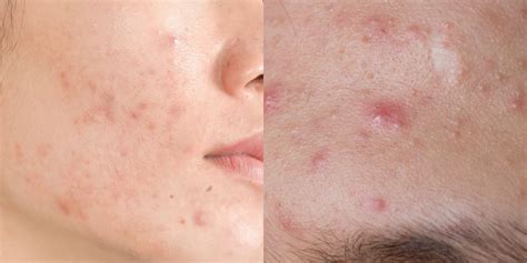 Dont let acne advance Acne, Acne help, Prevent acne