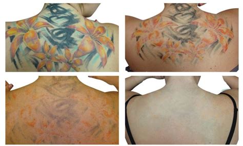 Where to Get Laser Tattoo Removal in Toronto? Chronic Ink