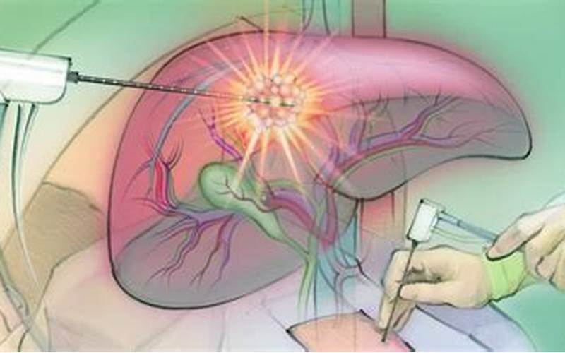 How Imaging-Guided Tumor Ablation Works