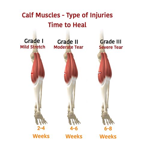 How Long Does A Torn Calf Muscle Take To Heal?