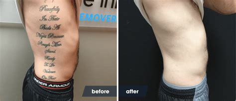 27+ How Long Does Laser Tattoo Removal Heal vichevendila