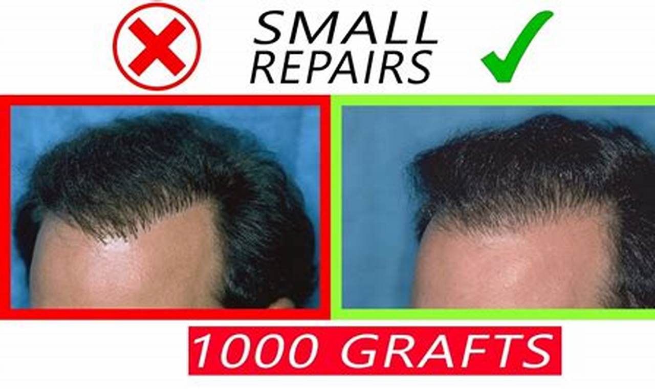 How Many Hairs In 1000 Grafts