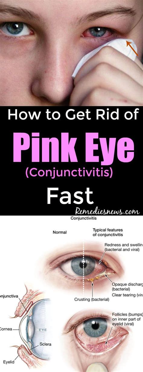 How To Cure Pink Eye (Conjunctivitis)