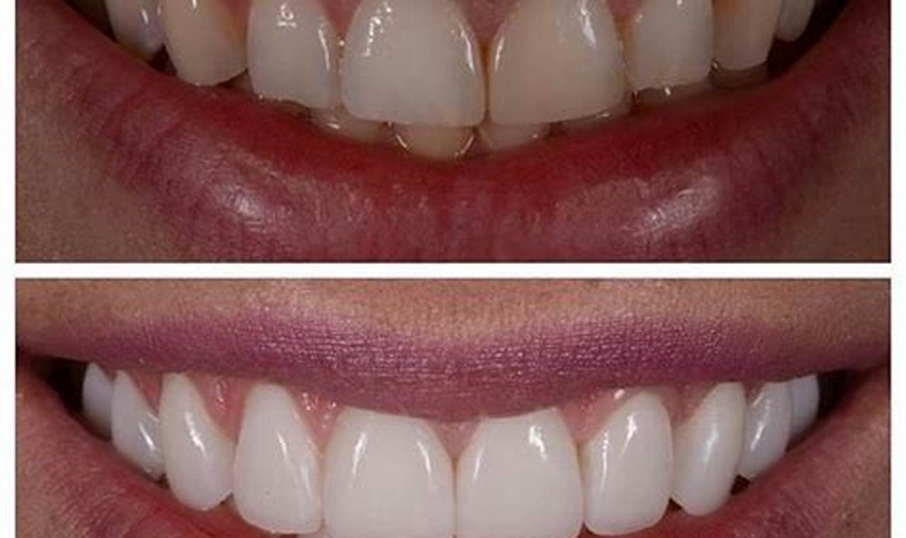 How To Polish Composite Veneers At Home
