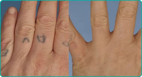 Can Tattoos Be Removed How To Remove Tattoos At Home For