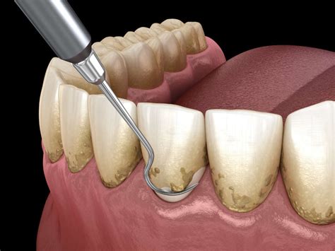 Famous How To Get Rid Of Plaque On Teeth Without Going To The Dentist