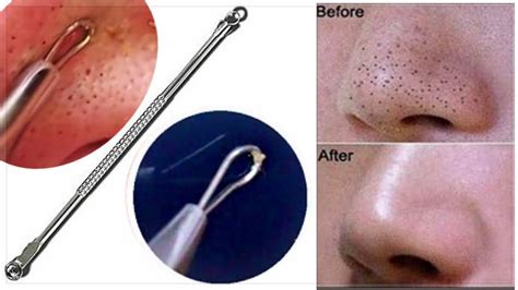 Homemade Blackheads Remover Tutorials and Ideas Hative