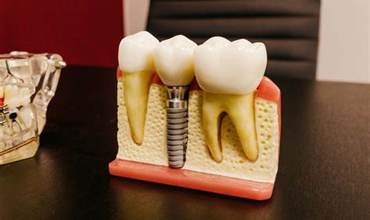 How To Whiten Dental Implants At Home