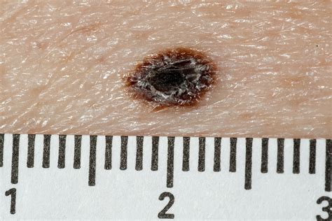 How is Junctional Melanocytic Nevus with Mild Atypia Treated?