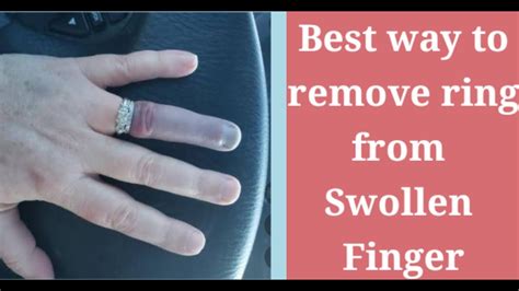 How to Get a Ring Off a Swollen Finger