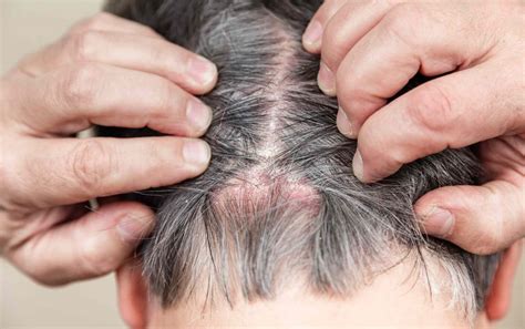 How to Help Hair Grow Back After a Scab