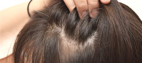 How to Tell if Hair is Thinning