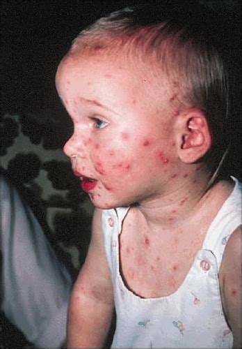 How Are Chickenpox and Shingles Related Quizlet