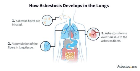How Asbestos Fibers Cause Damage