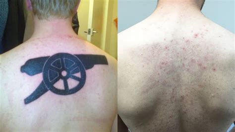 Laser Tattoo Removal How Bad Does It Hurt? First