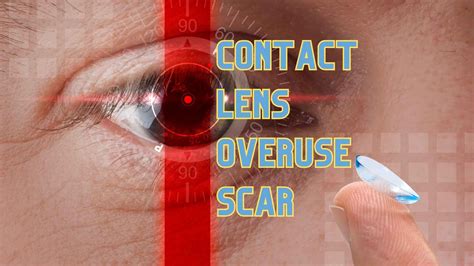 How Contact Lens Overuse Contributes to Goo
