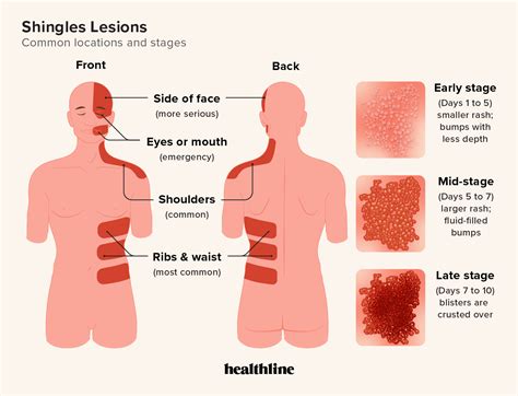 How Contagious Is Shingles