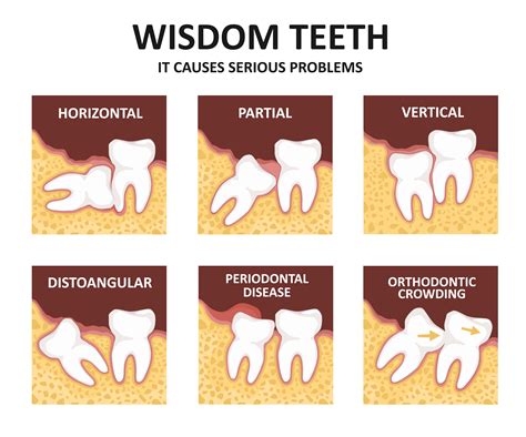 Do You Need a Referral for Wisdom Teeth Removal