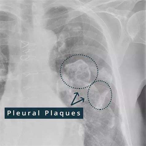 How Do Pleural Plaques Develop
