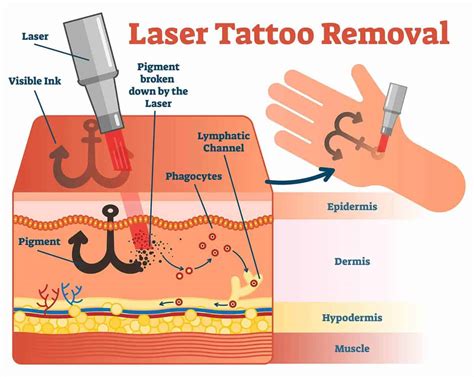 How Do Tattoo Removal Lasers Work
