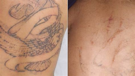 Tattoo Removal Procedure How To Remove Tattoos From