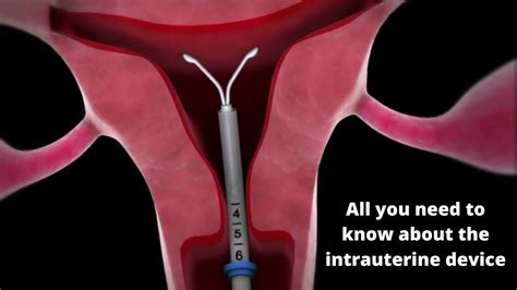 How Does An Iud Work