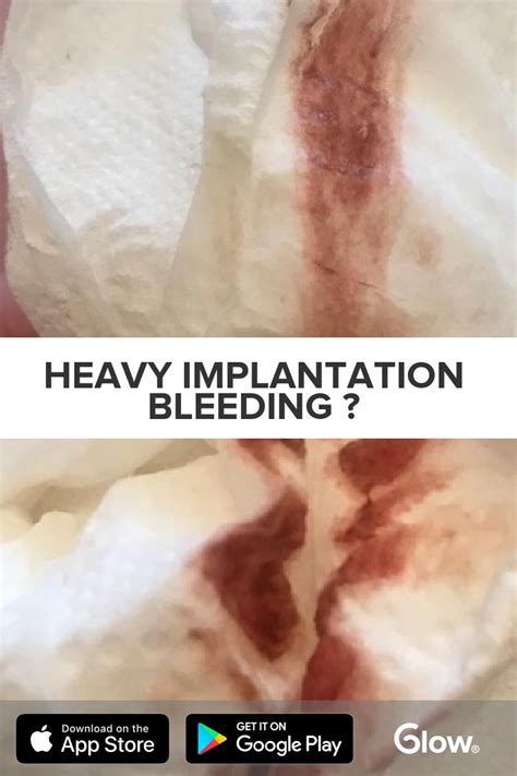 How Does Heavy Implantation Bleeding Look Like