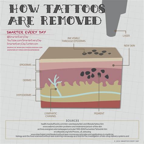 How Does Laser Tattoo Removal Work