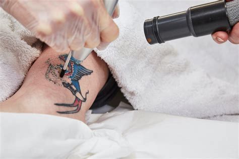 Laser Tattoo Removal ClearLift laser Harmony XL Pro Blog