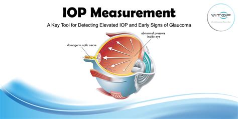 How Eye Drops Combat High Intraocular Pressure (IOP)