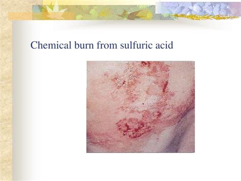 The Acidic Velocity: How Quickly Sulfuric Acid Can Inflame and Damage Your Skin