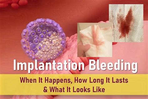 How Long Does Implantation Bleeding Look Like
