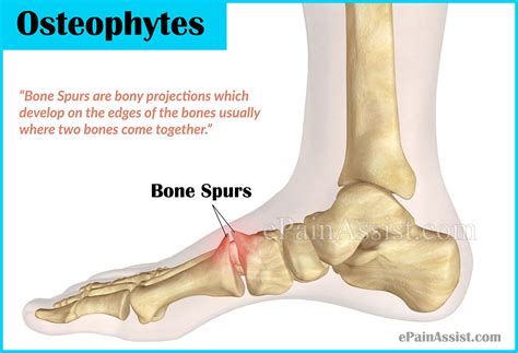 How Long Does It Take For Bone Spurs To Develop