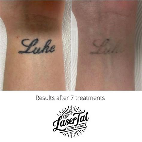 Laser tattoo removal at Revekka Treatments