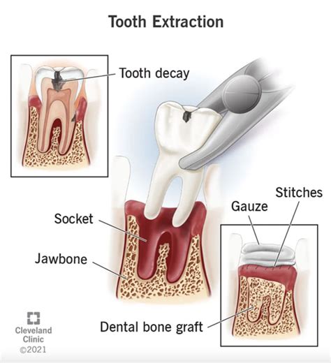 How long does molar extraction take?