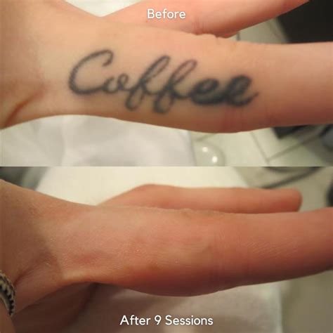 Laser tattoo removal How does it work, how long does it