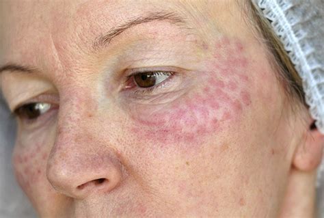 The Ultimate Guide to Post-Microneedling: The Mystery of How Long Your Skin Stays Red Unveiled!