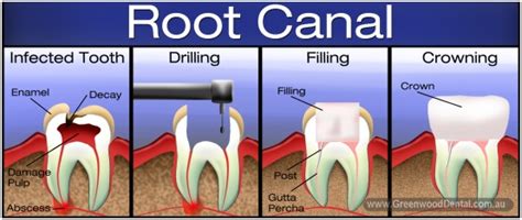 How Long To Wait For Permanent Filling After Root Canal