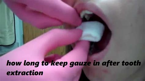 Gauze after tooth extraction