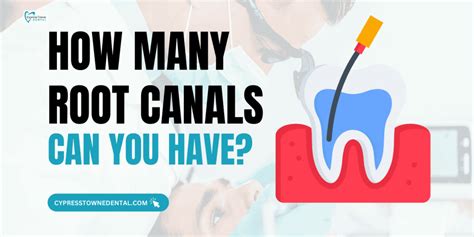 How Many Root Canals Can You Have