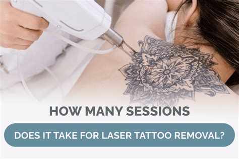 How Many Sessions Of Laser Tattoo Removal