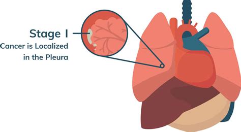 How Mesothelioma Progresses
