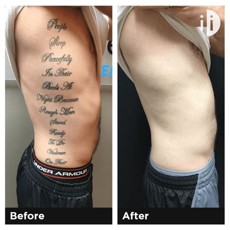 Tattoo Removal Near Me Is Tattoo Removal Worth It How Much