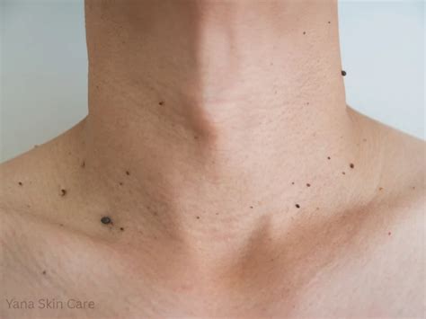The Cost-Conscious Guide to Skin Tag Removal: How Much Does it Really Cost Without Insurance?