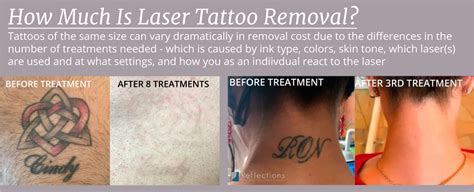 Laser Tattoo Removal Cost Infinity Laser Spa, NYC